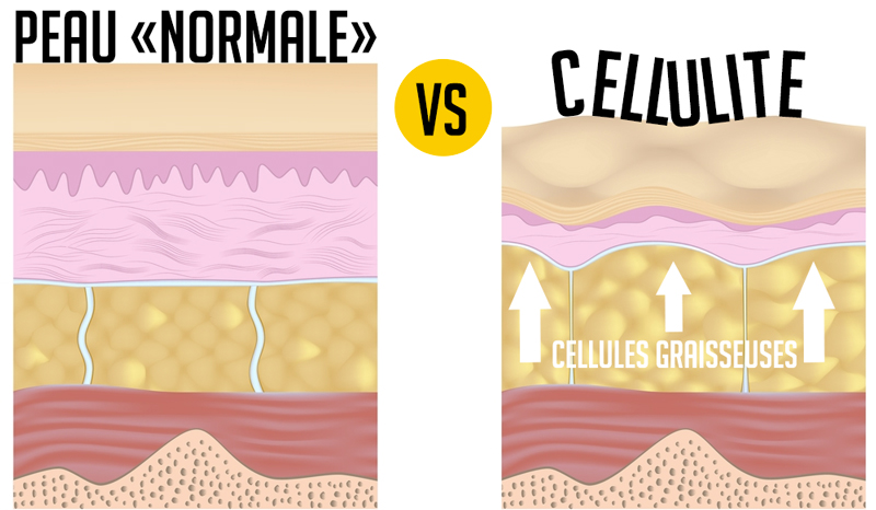 cellulite